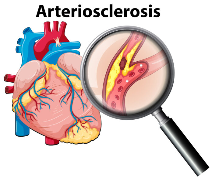 Atherosclerosis Treatment